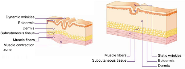 Facial-wrinkles-types